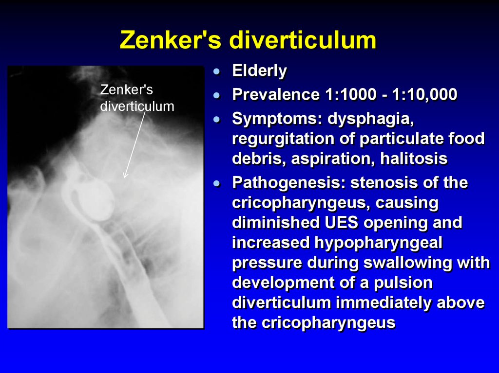 Zenker's diverticulum