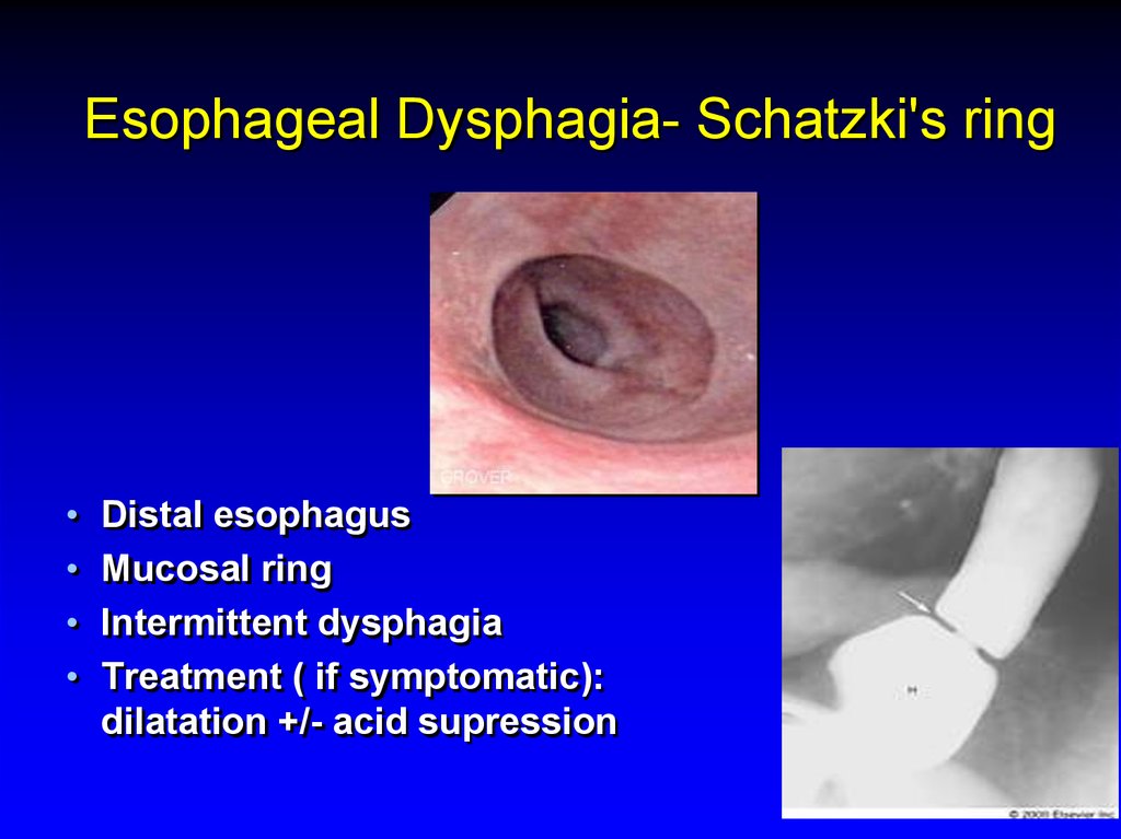 Esophageal Dysphagia- Schatzki's ring
