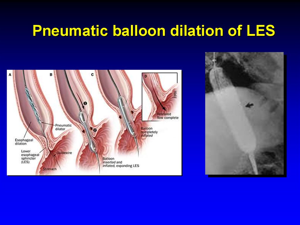 Pneumatic balloon dilation of LES