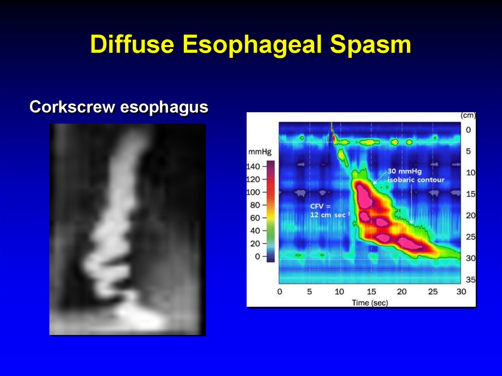 Diffuse Esophageal Spasm