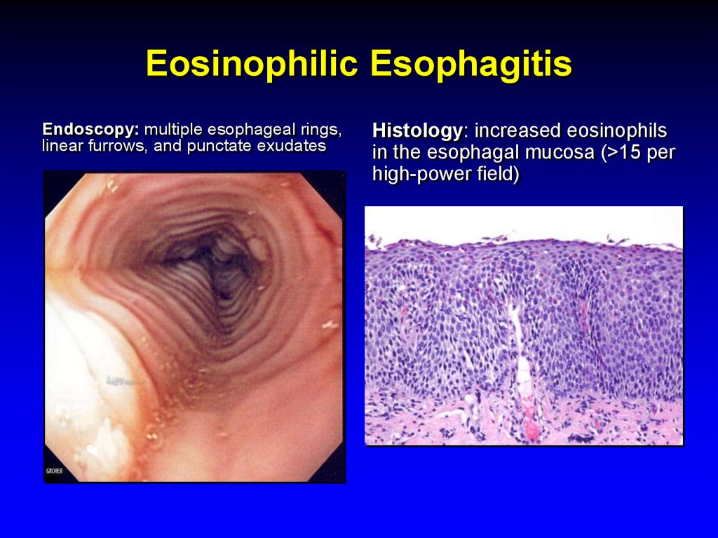 Dieta esofagitis eosinofílica