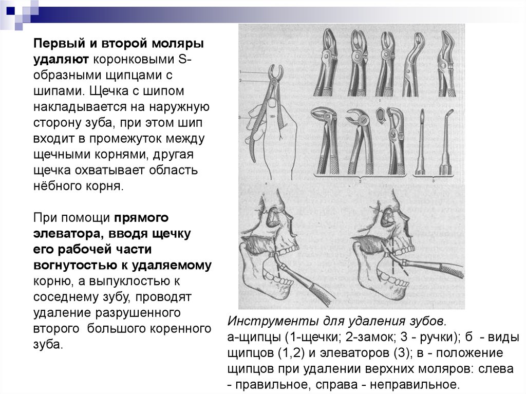 Удаление второго. S-образными щипцами с шипом удаляют. S- образными щипцами с шипами.. S образные щипцы для моляров верхней челюсти.