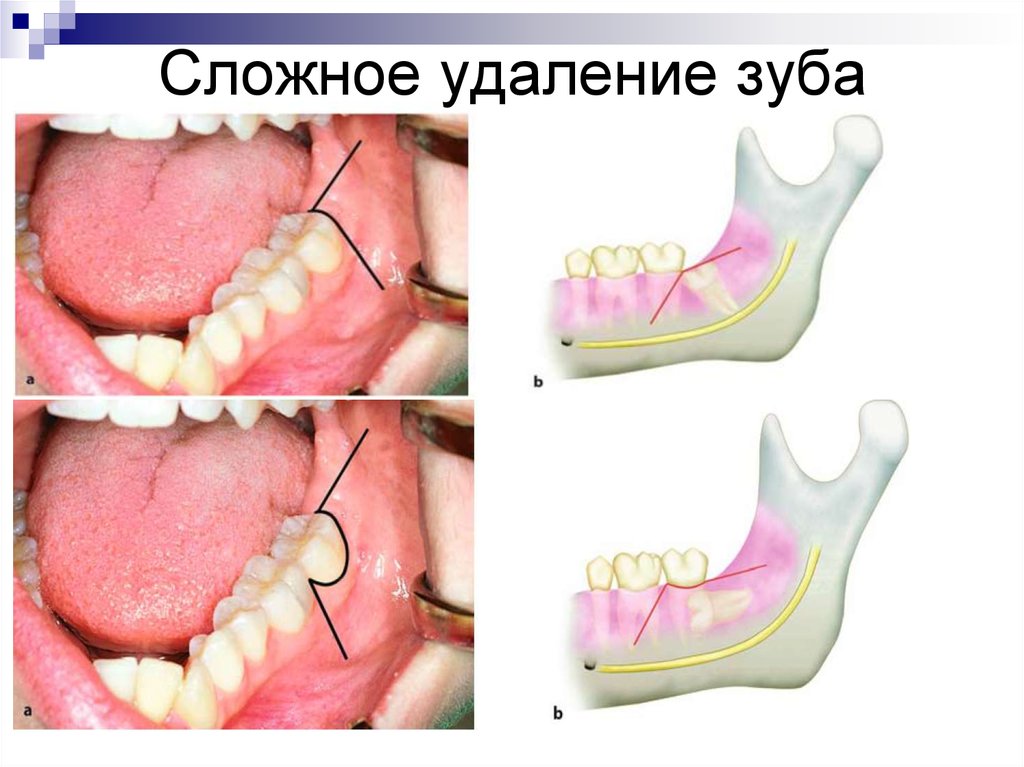 Реферат: Операція видалення зуба
