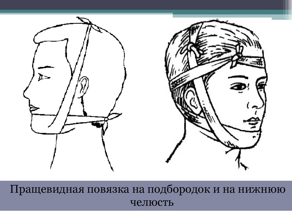 Пращевидная повязка рисунок