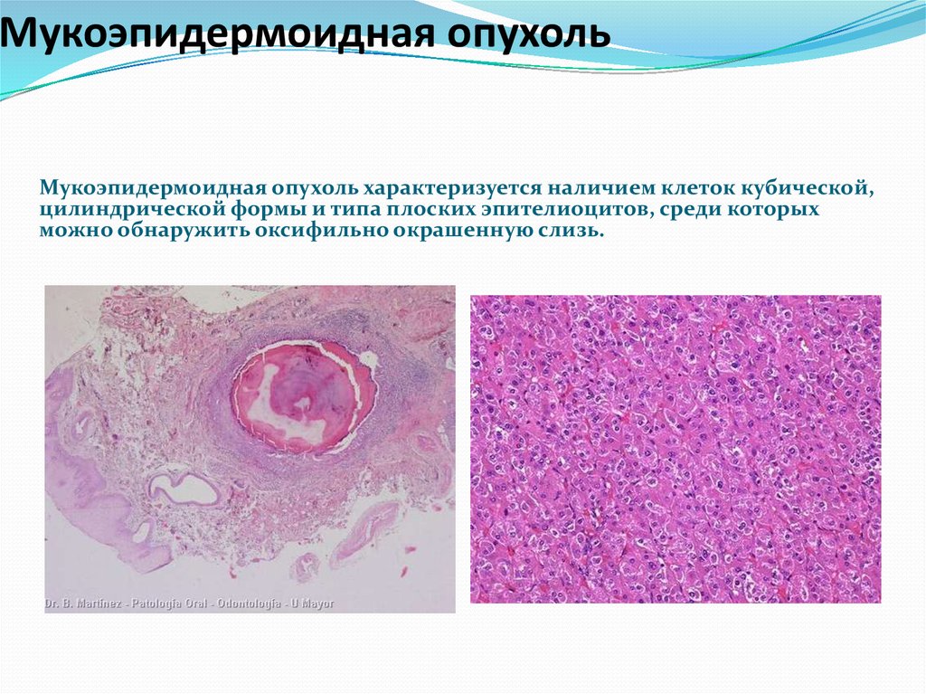 Опухоль слюнной железы фото