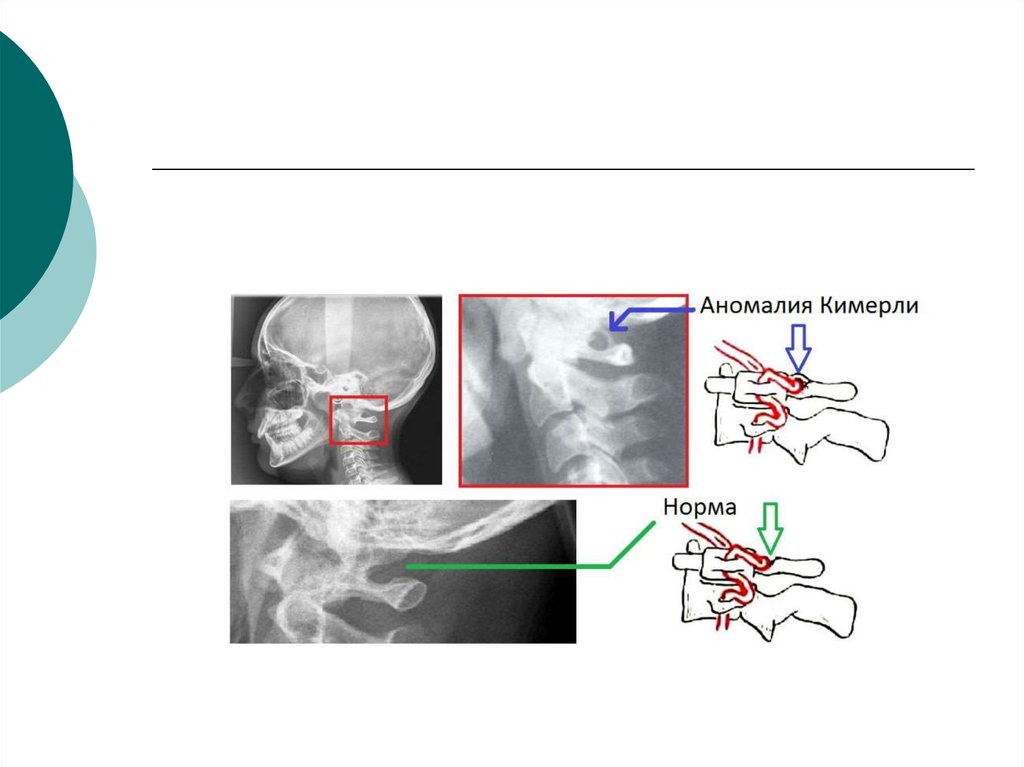 Аномалия киммерли у ребенка. Аномалия Киммерле рентген. Рентген с неполной аномалией Киммерле. Неполная аномалия Киммерли рентген. Позвоночная артерия аномалия Киммерли.