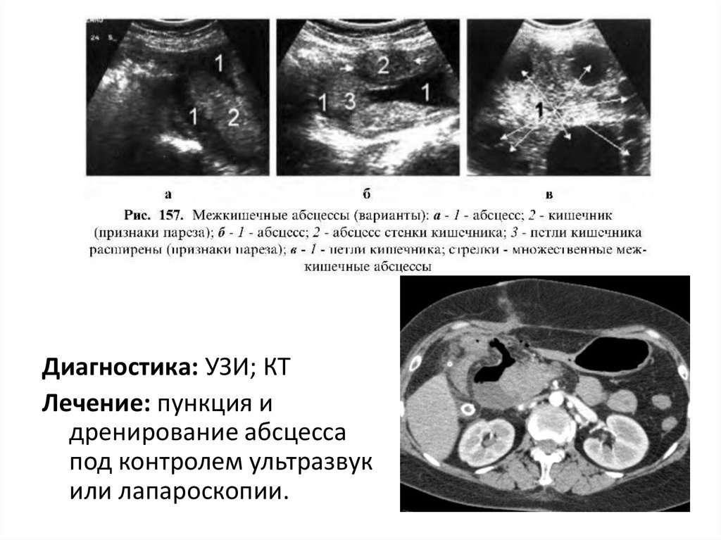 Перитонит госпитальная хирургия презентация