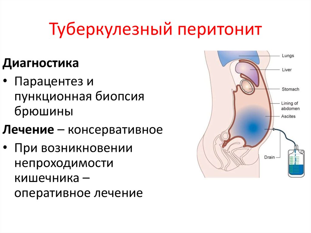 Перитонит лечится. Туберкулезный перитонит. Туберкулезный перитонит диагностика.