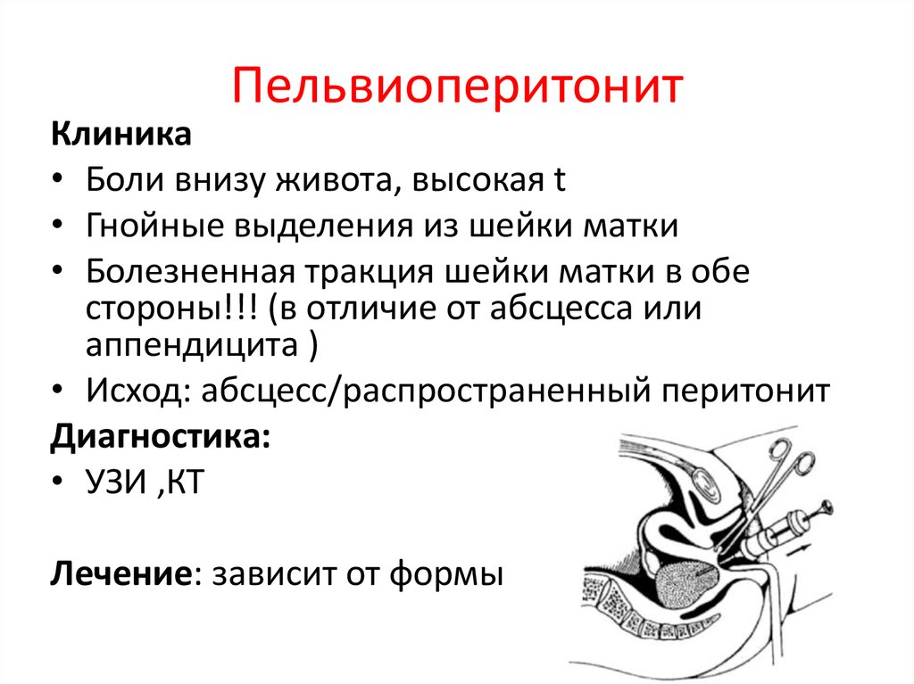 Клиническая картина пельвиоперитонита