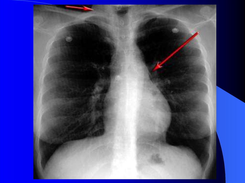 1 легкое меньше другого. Рентген снимок при бронхиальной астме. Бронхиальная астма рентгенологическая картина. Бронхиальная астма снимок флюорографии. Бронхиальная астма на рентгене легких.