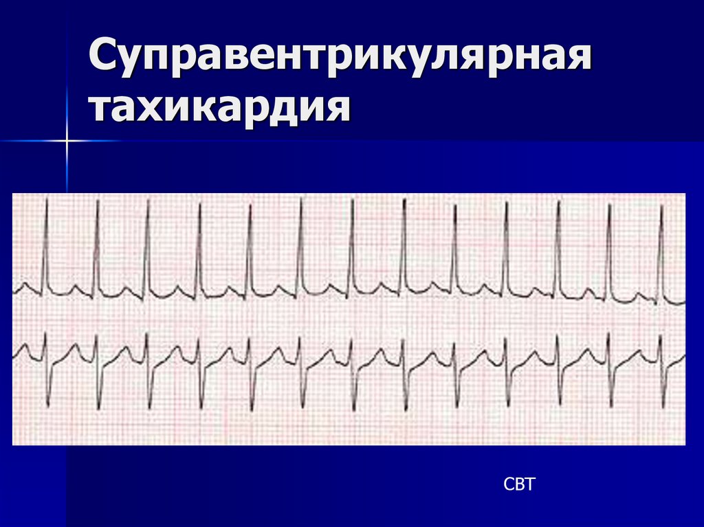 Наджелудочковая тахикардия презентация