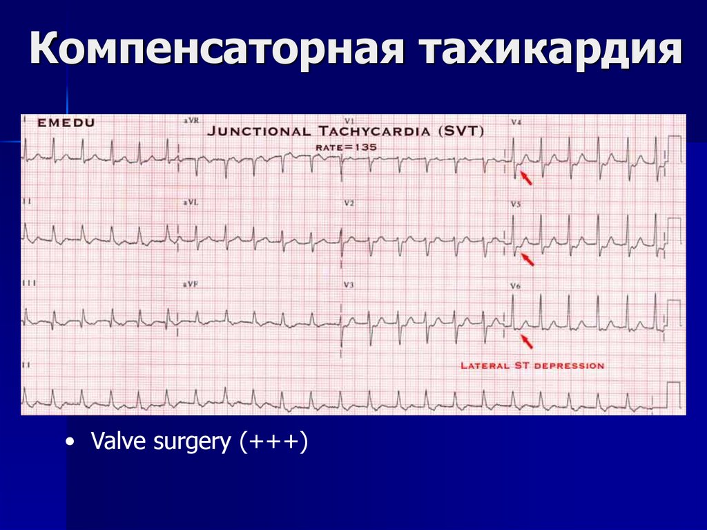 Тахикардия сердца что это такое. Тахикардия. Тахикардия кардиограмма. Кардиограмма при тахикардии. Тахикардия по ЭКГ.