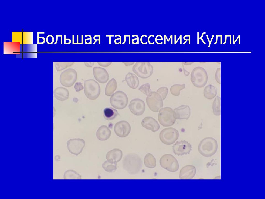 Талассемия клиническая картина