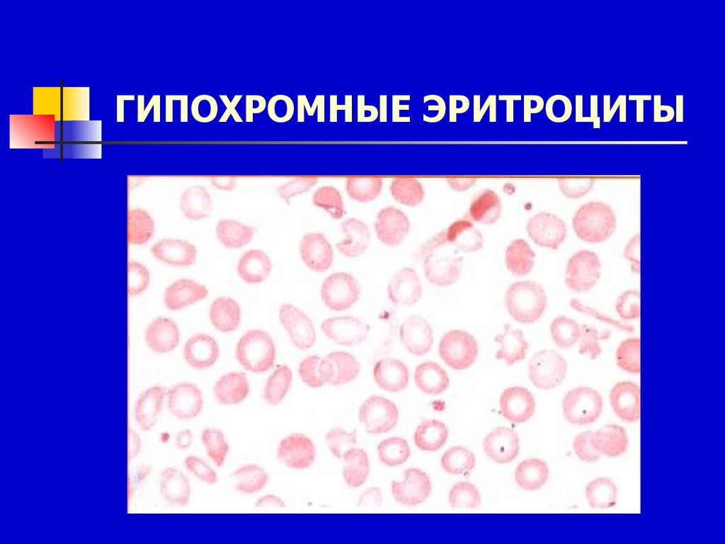 Гипохромия железодефицитная анемия. Гипохромия микроцитоз. Гипохромная анемия эритроциты. Гипохромия и микроцитоз эритроцитов. Анизоохромные эритроциты.