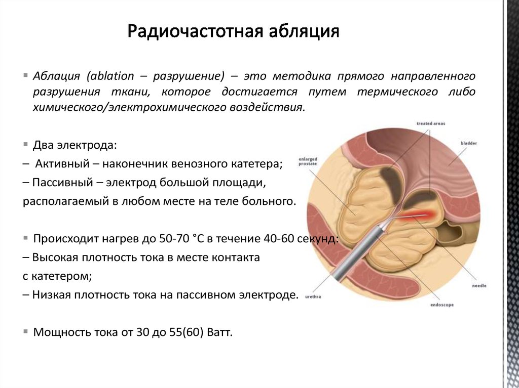 Рча отзывы. Радиочастотная абляция. Высокочастотная абляция сердца. Радиочастотная катетерная абляция. Радиочастотная абляция сердца.