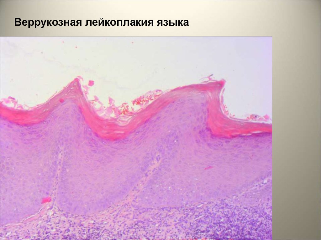 Слизистая оболочка полости. Веррукозная лейкоплакия гистология. Лейкоплакия слизистой полости. Веррукозная лейкоплакия слизистой. Веррукозная лейкоплакия слизистой рта.