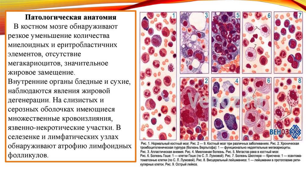 Жировая дегенерация костного мозга