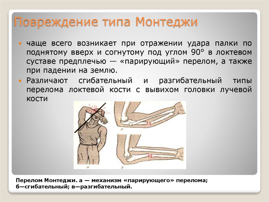 Повреждение это. Переломовывих Монтеджи. Повреждения предплечья типа Монтеджи. Перелом Монтеджи и Галеацци. Перелом вывих Монтеджи.