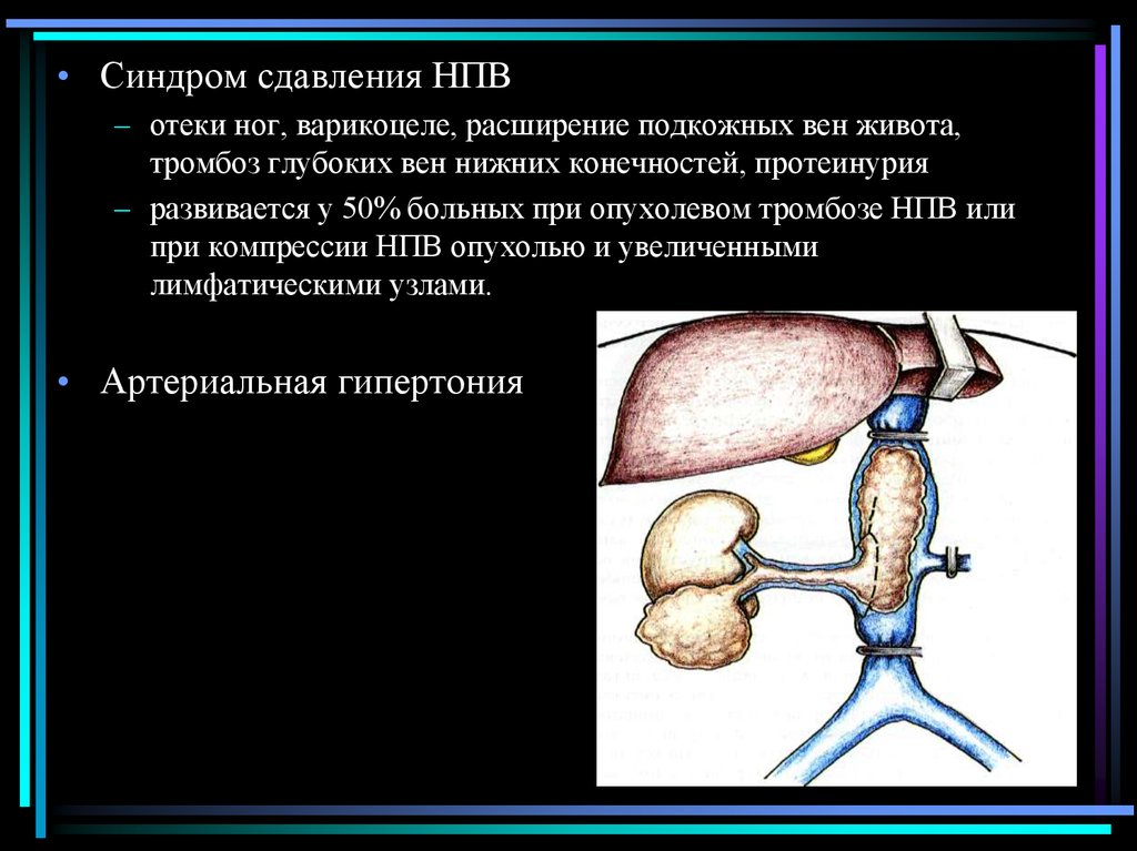 Корни нижней полой вены. Синдром нижней полой вены. Сдавление нижней полой вены. Сдавливание нижней полой вены. Синдром сдавливания нижней полой вены.