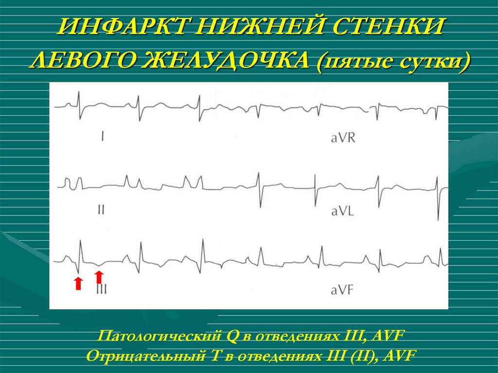 Экг опасно