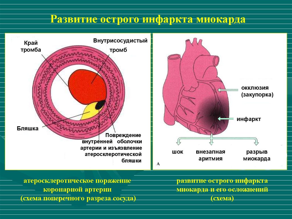 Ишемическая стадия инфаркта миокарда