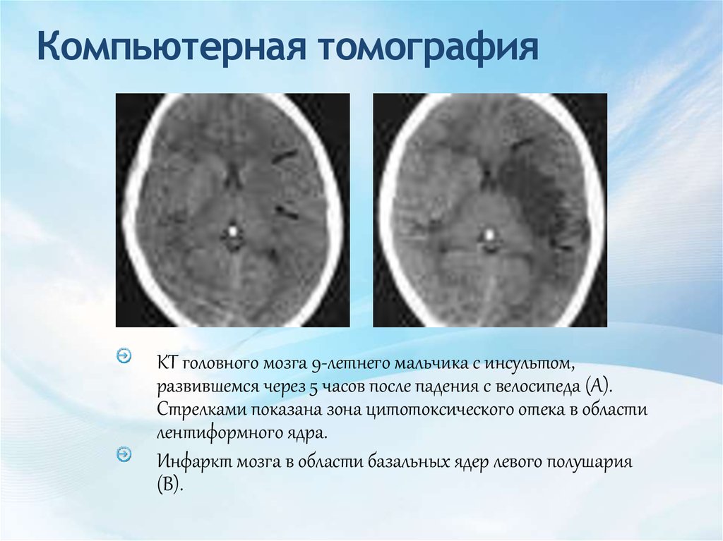 Оттек головного мозга. Вазогенный отек мозга на кт. Цитотоксический отек мозга на кт. Цитотоксический отек головного мозга кт. Геморрагический инсульт кт.