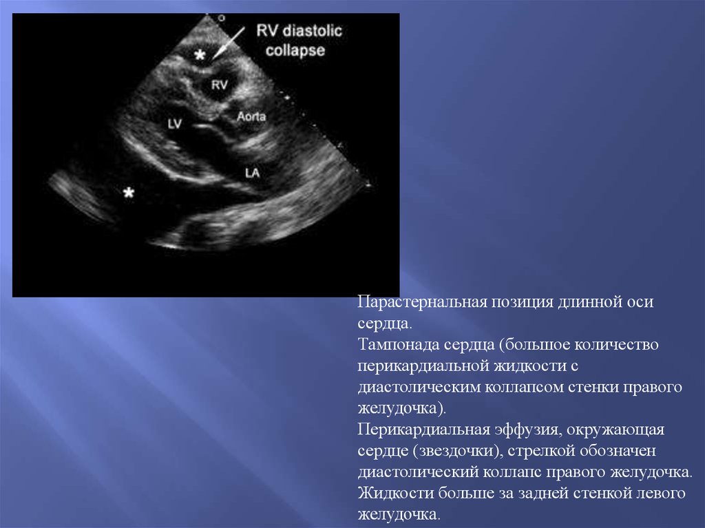 Стенки правого желудочка. Правый желудочек парастернальная позиция норма. Диастолический коллапс правого желудочка. Парастернальная позиция по длинной оси правого желудочка краб. Передняя стенка правого желудочка на УЗИ.