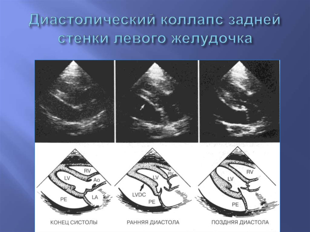 Диастолическая левого желудочка. Диагональная трабекула левого желудочка. Доп трабекула левого желудочка. Дополнительная трабекула в полости левого желудочка. Диагональная Дополнительная трабекула левого желудочка.