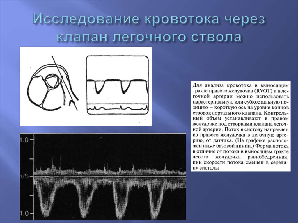 Исследование тракта. Скорость кровотока в выносящем тракте правого желудочка. Скорость кровотока в легочной артерии. Скорость потока крови в легочной артерии. Время ускорения потока в выносящем тракте правого желудочка.