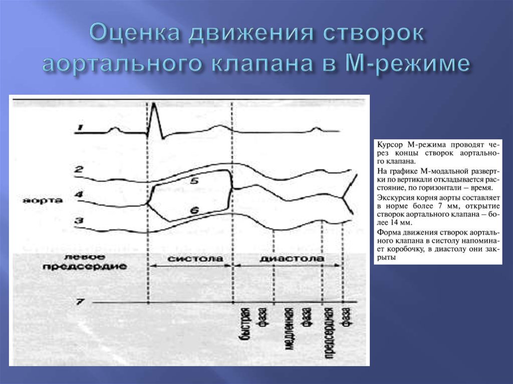 М нормальный. Систолическое дрожание створок аортального клапана. Створки аориальнго клапан. Нормва аортальногоклапана. Движение створок митрального клапана в норме.