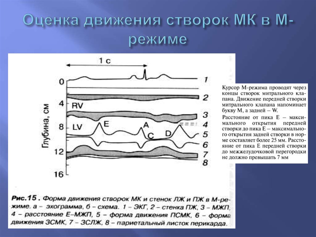 Оценка движения. М режим митрального клапана. Движение створок митрального клапана в противофазе. М-образное движение створки митрального клапана. Форма движения передней створки митрального клапана.