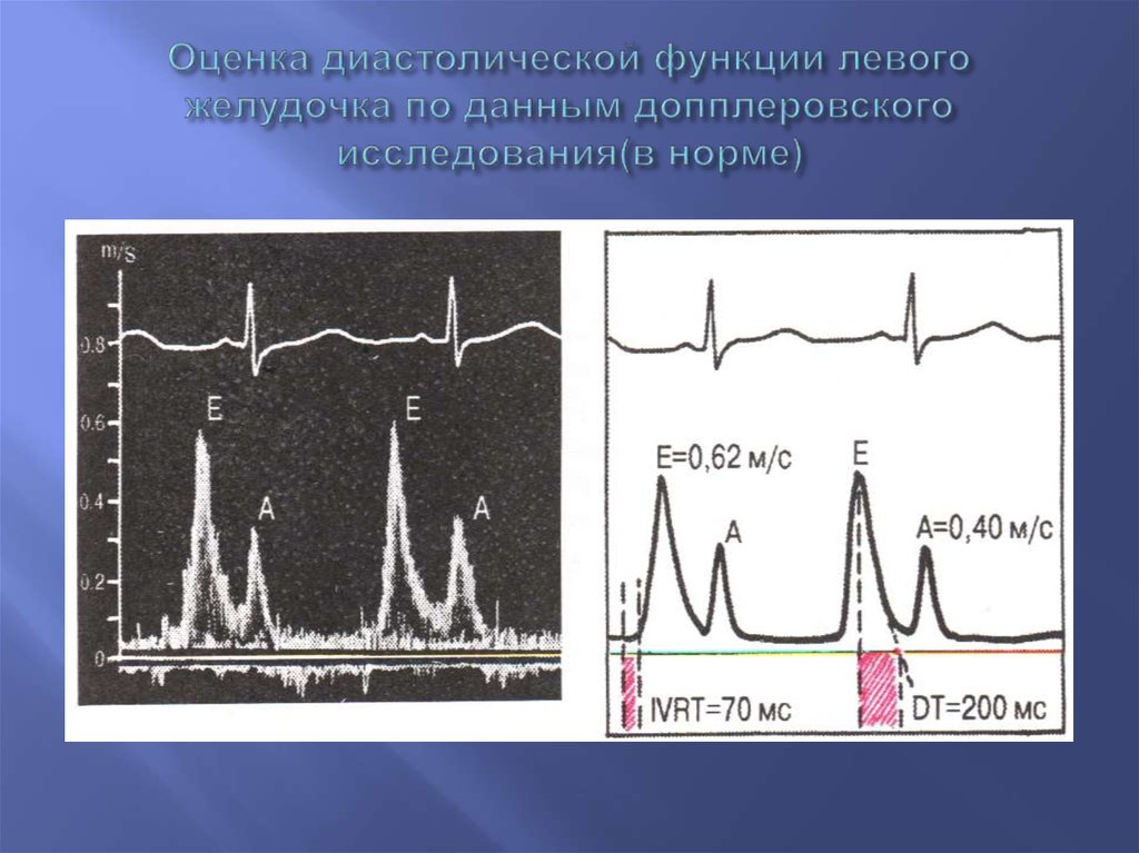 Диастолическая левого желудочка. Оценка диастолической функции сердца. Оценка диастолической функции лж. Диастолическая функция тканевой доплер. Эхокардиография диастолическая дисфункция левого желудочка.