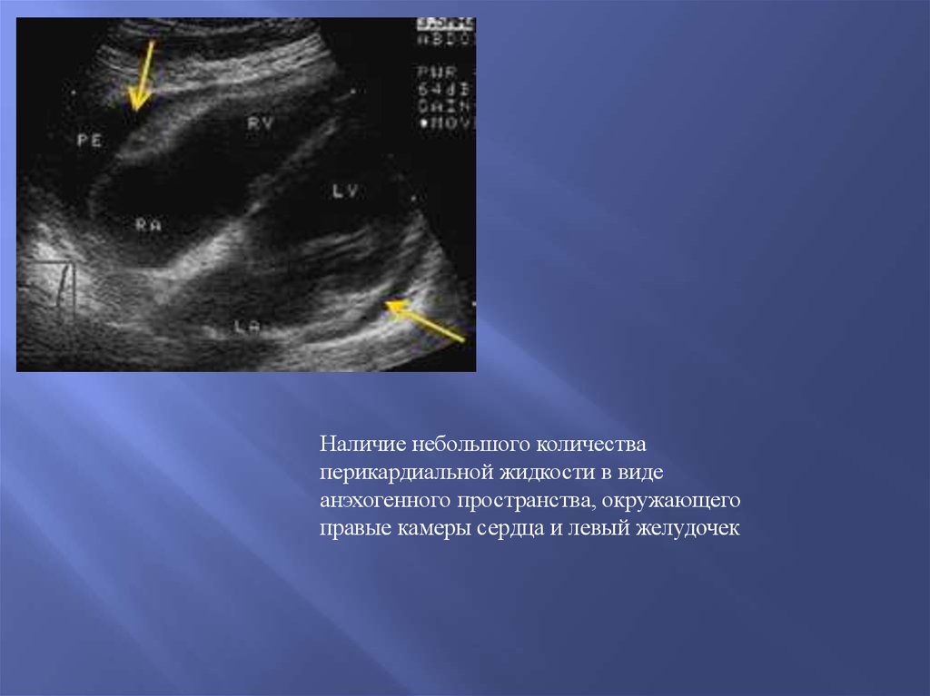Анэхогенное образование. Перикардиальная киста ЭХОКГ. Скопление анэхогенной жидкости. Перикардиальный жир при эхокардиографии.