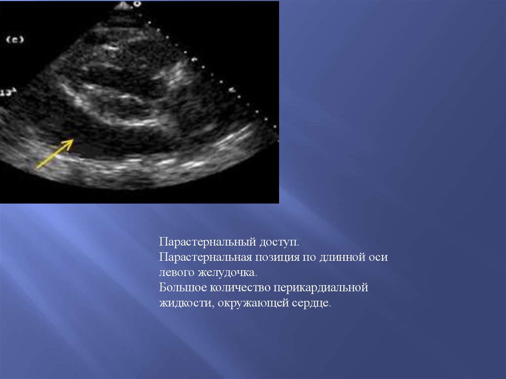 Длинная ось. УЗИ парастернальная позиция длинная ось левого желудочка. ЭХОКГ длинная ось левого желудочка. Парастернальная позиция длинная ось левого желудочка. Парастернальный доступ длинная ось левого желудочка.