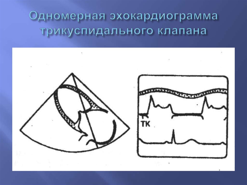 Пластика трикуспидального клапана