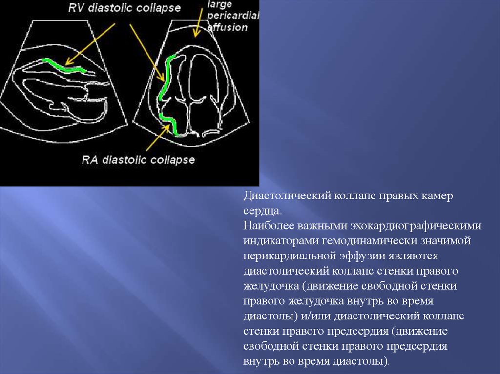 Стенки левого желудочка. Коллапс стенки правого предсердия. Диастолический коллапс. Коллабирование правого предсердия. Диастолический коллапс правого желудочка.