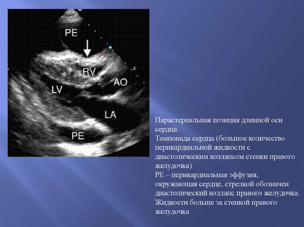 Стенки правого желудочка. Тампонада сердца на ЭХОКГ. Тампонада сердца Эхо кг. Тампонада сердца УЗИ. Длинная парастернальная ось сердца.
