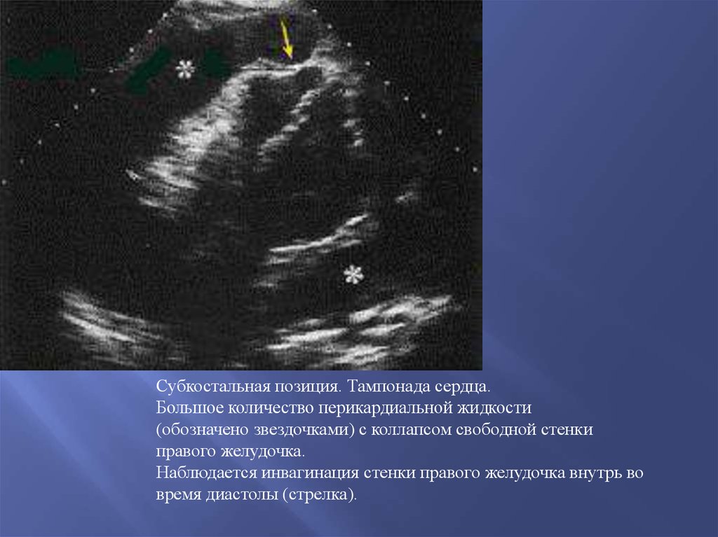 Стенки правого желудочка толще стенок левого. Субкостальная позиция ЭХОКГ. Субкостальная позиция в эхокардиографии. Свободная стенка правого желудочка.