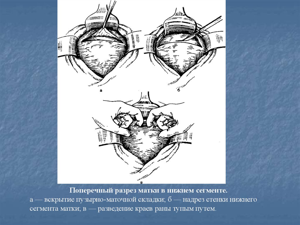 Сечение матки операция