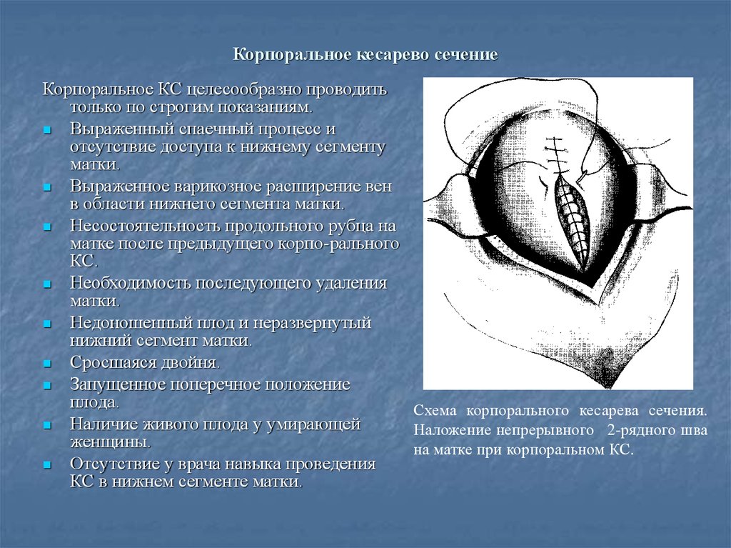 Натальная карта кесарево сечение