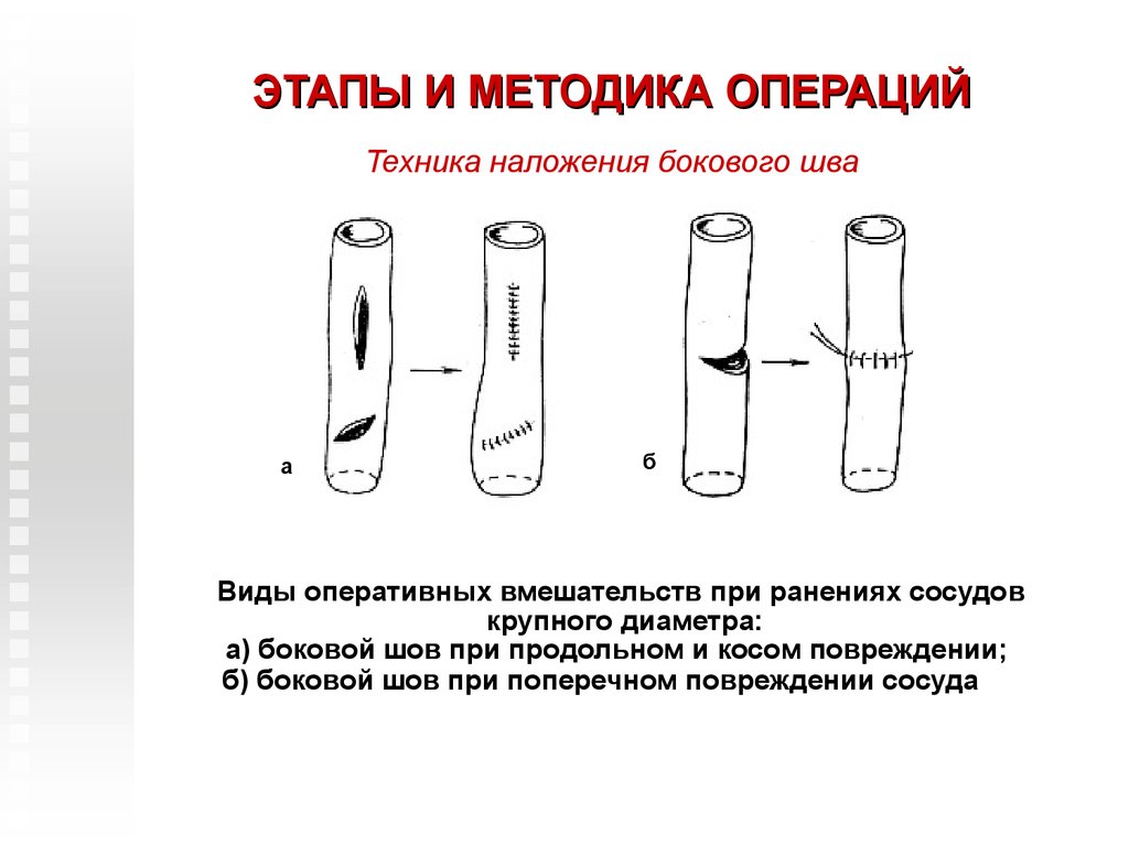 Методика операций. Повреждение кровеносных сосудов. Ранение кровеносных сосудов. Боковой сосудистый шов.