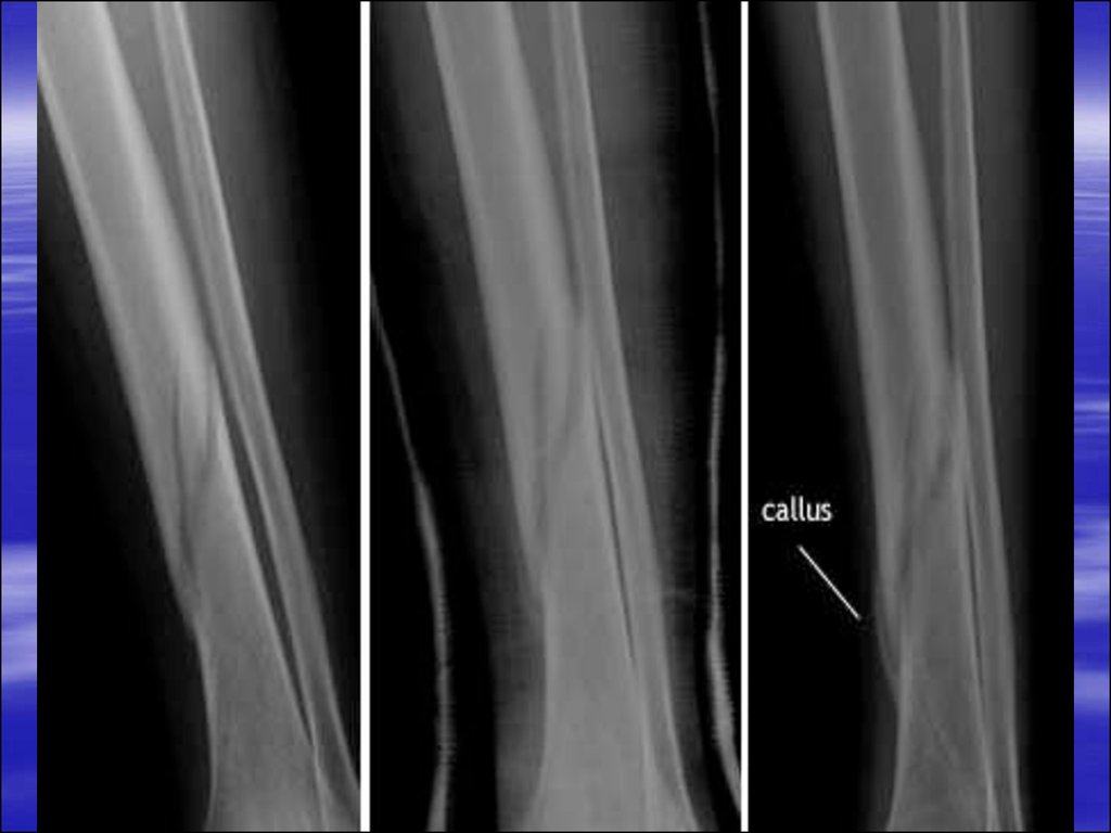 Кость после перелома. Костная мозоль после перелома берцовой кости на снимке. Рентген сросшегося перелома берцовой кости. Костная мозоль после перелома большеберцовой кости.