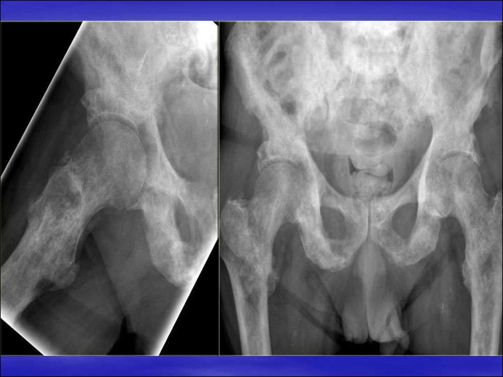 Рак бедра. Остеобластические метастазы рентген. Остеобластические метастазы костей таза. Остеобластические метастазы таза рентген. Остеобластические метастазы в кости таза рентген.