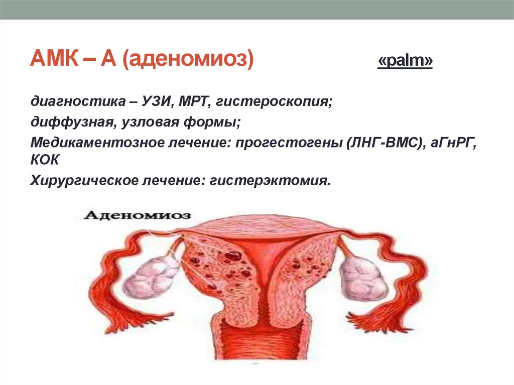 Диффузная форма матки. Эндометриоз тела матки (аденомиоз). Формы аденомиоза матки.