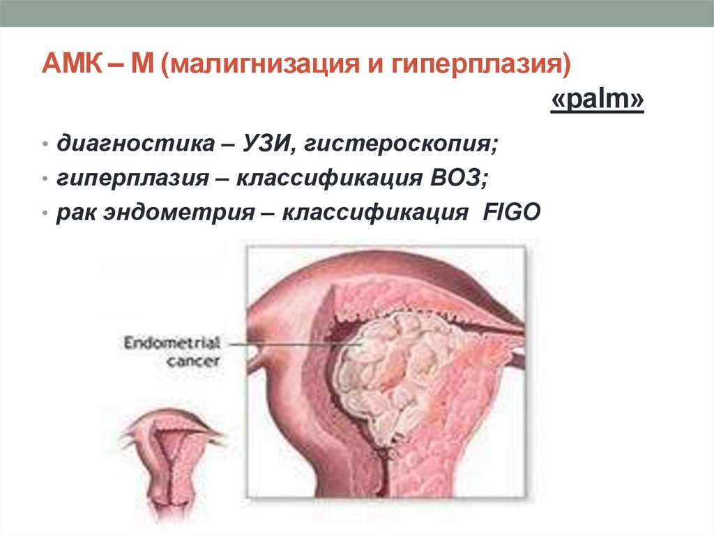 Гиперплазия эндометрия матки фото