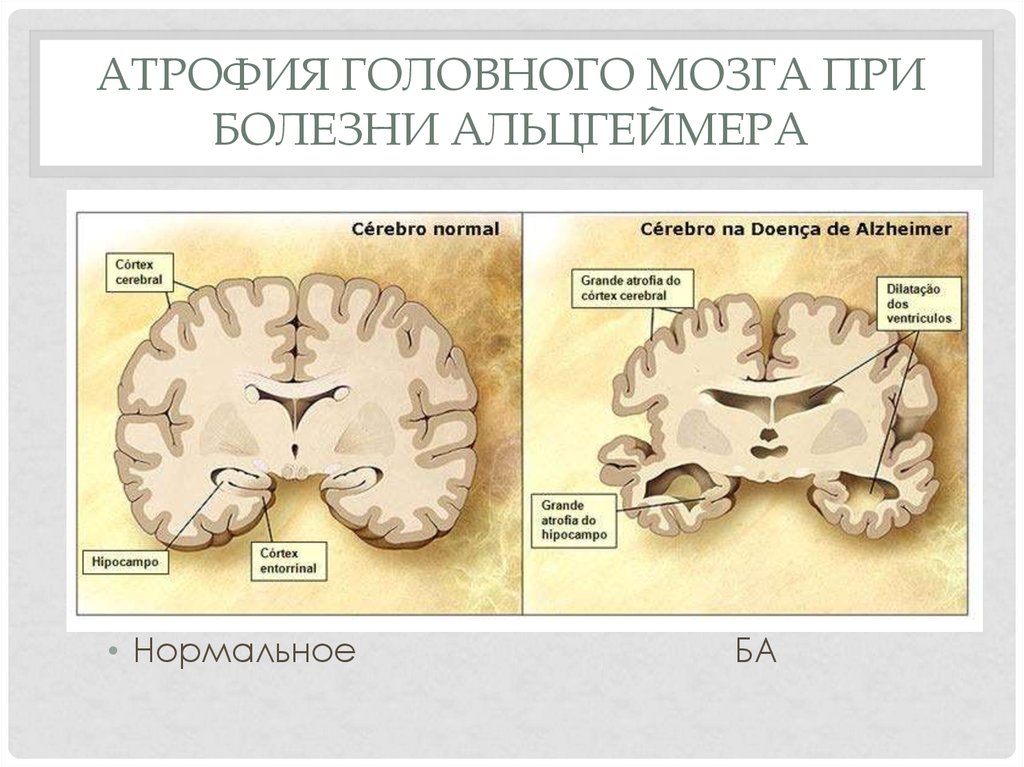 Изменения мозга при болезни Альцгеймера. Атрофические процессы головного мозга.