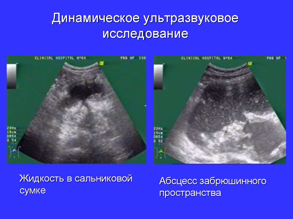 Абсцесс печени узи картина