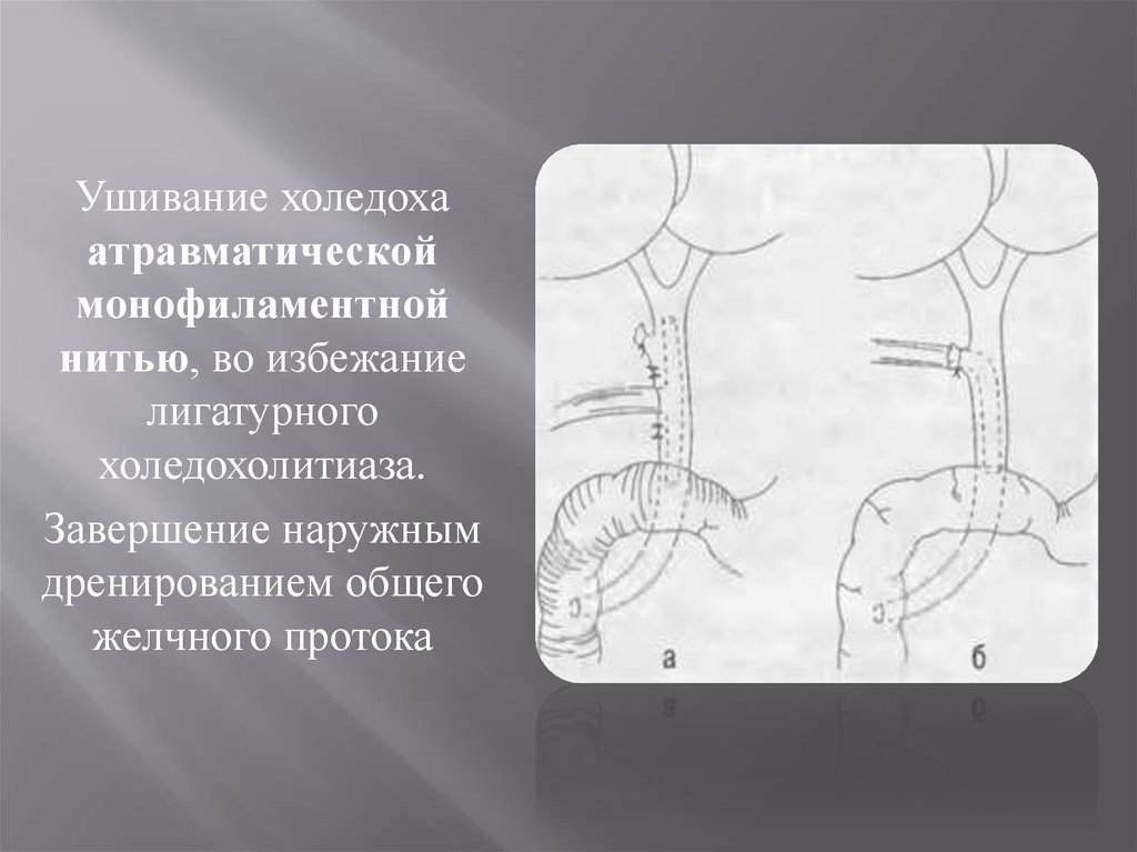 Сегменты холедоха схема