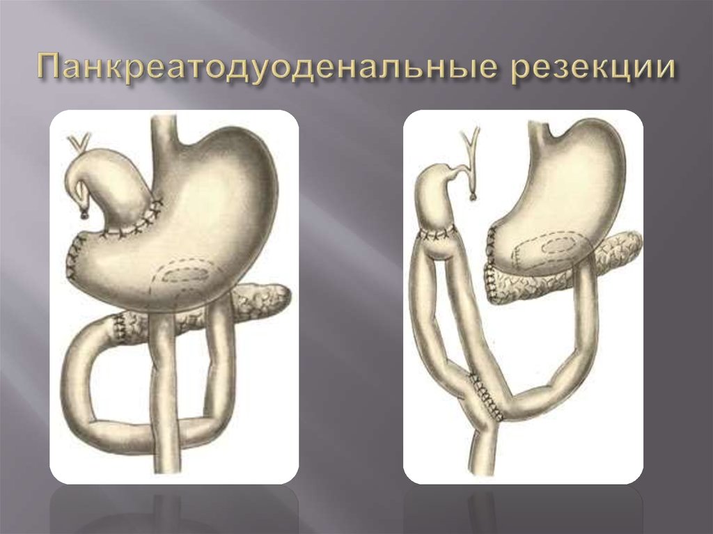 Панкреатодуоденальная резекция схема операции