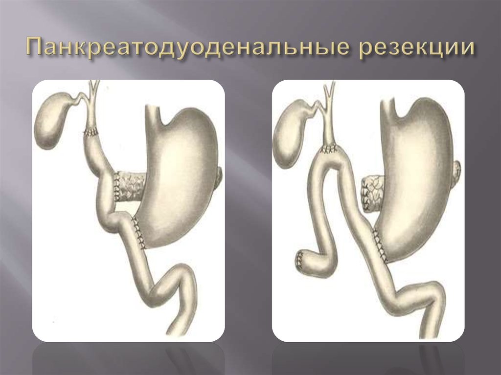 Панкреатодуоденальная резекция схема операции